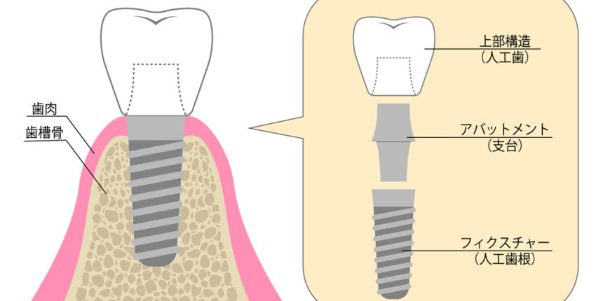 インプラント治療とは