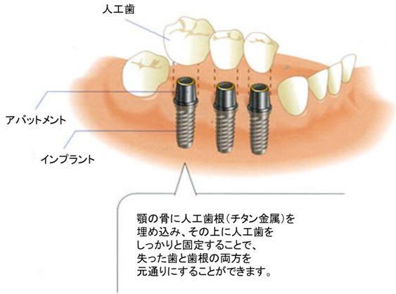 インプラントの上部構造について